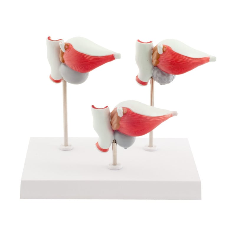3-Part Prostate Disease Model