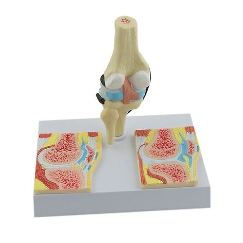 Rheumatic Knee Joint Model
