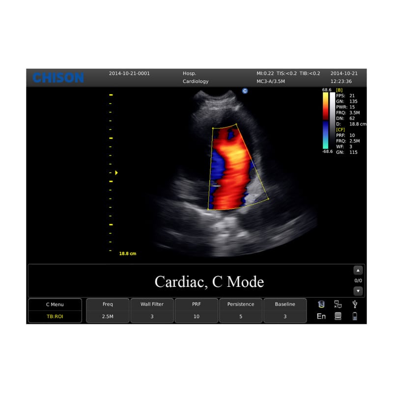 CHISON ECO5 Ultrasound Machine with Color Doppler + linear transducer