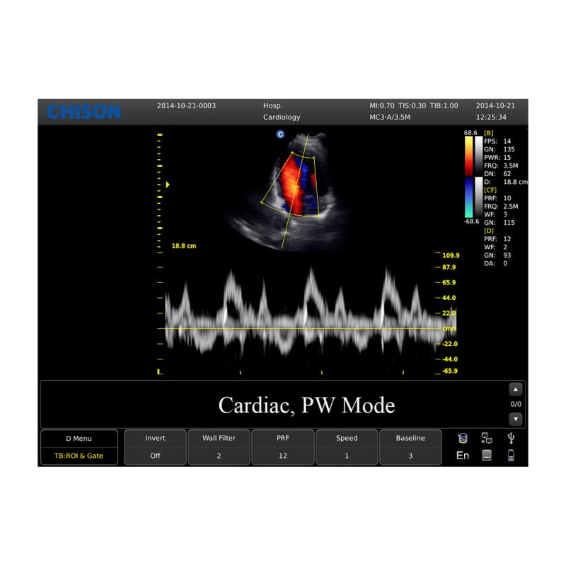 CHISON ECO5 Ultrasound Machine with Color Doppler + linear transducer