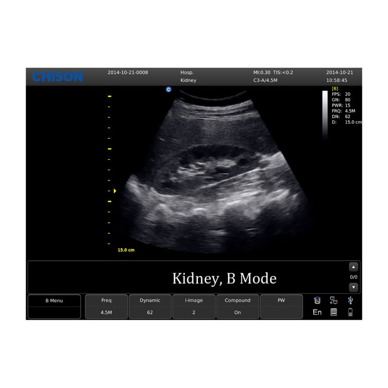 CHISON ECO5 Ultrasound Machine with Color Doppler + linear transducer