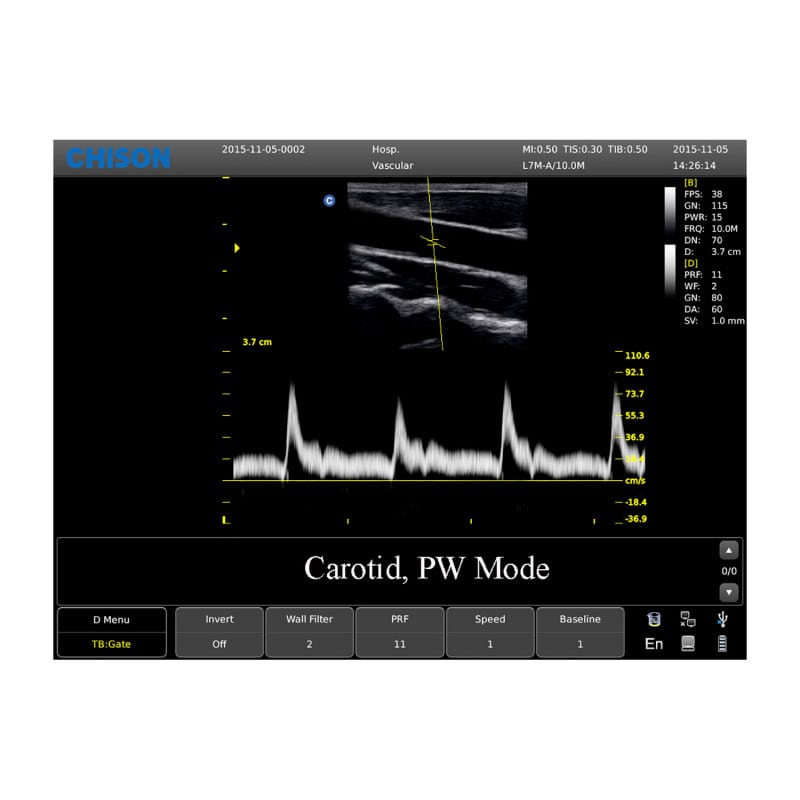 CHISON ECO3 Expert Ultrasound Machine with linear transducer (L7M-A)