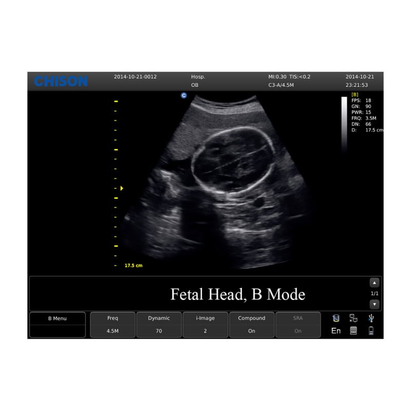 CHISON ECO3 Expert Ultrasound Machine with linear transducer (L7M-A)