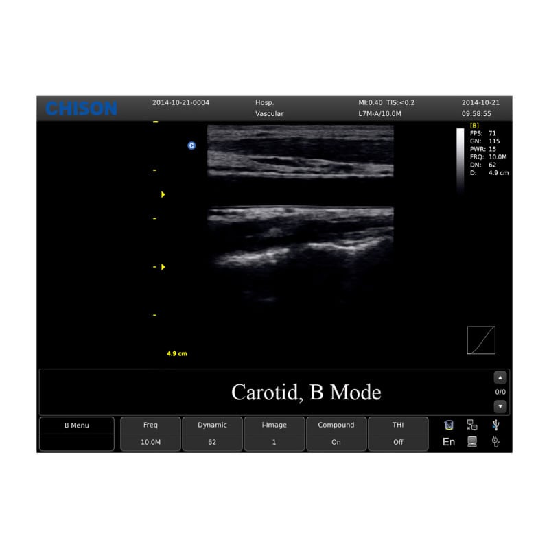 Chison ECO 1 Ultrasound Machine with rechargeable battery | convex transducer (C3-A)