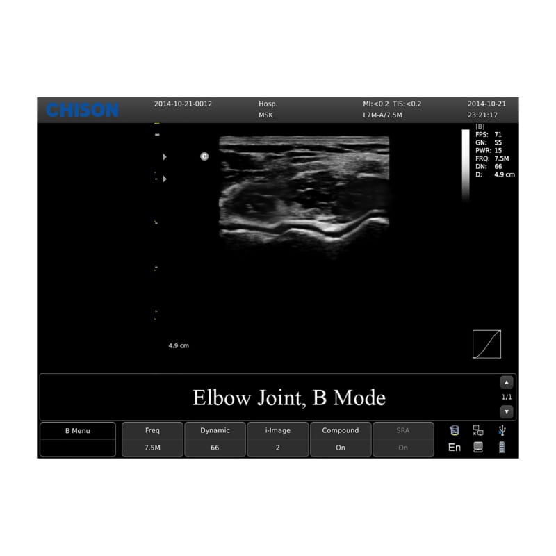 Chison ECO 1 Ultrasound Machine without rechargeable battery | linear transducer (L7M-A)