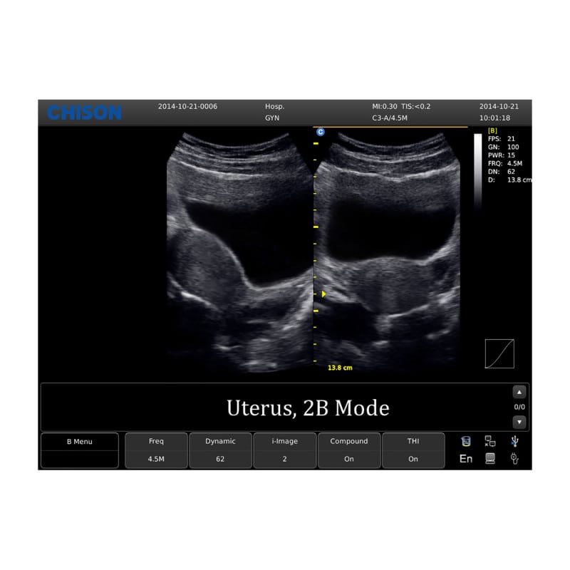 Chison ECO 1 Ultrasound Machine with rechargeable battery | linear transducer (L7M-A)