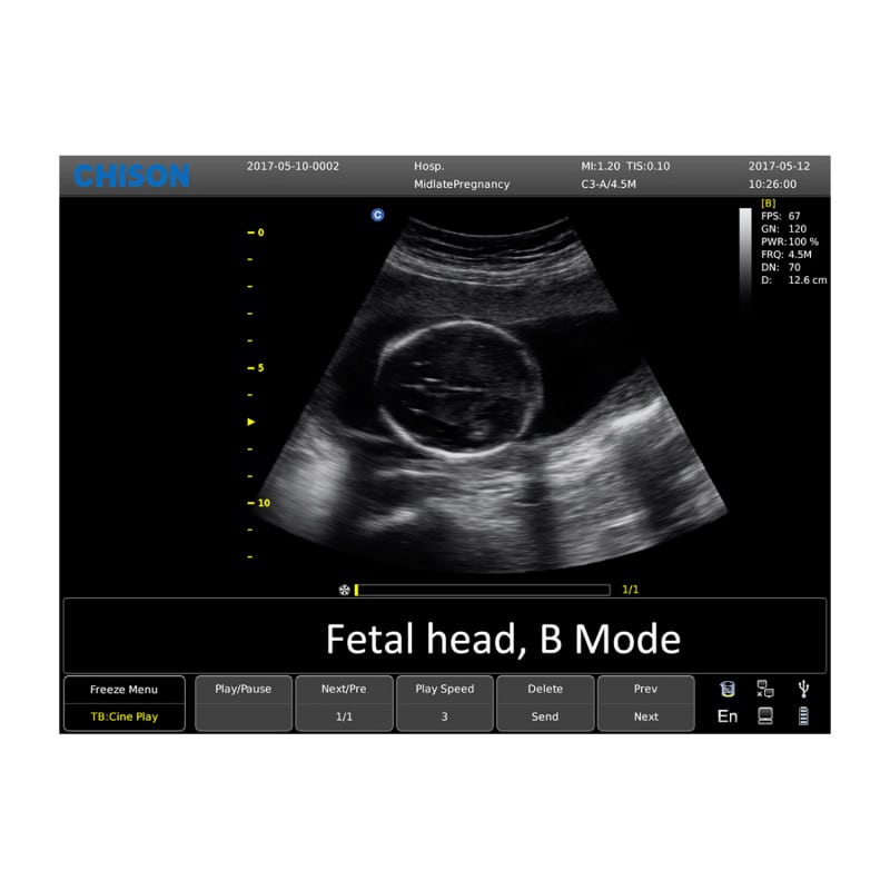 Chison ECO 6 Ultrasound Machine with C3-A convex transducer & P3-A phased array transducer