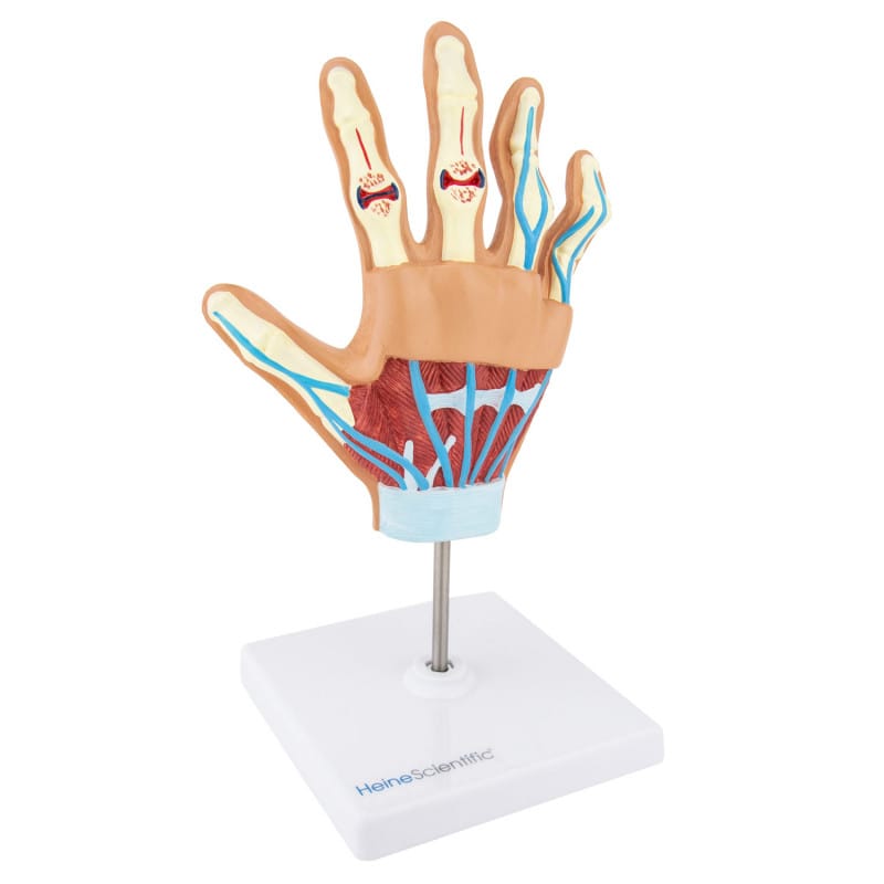 Hand Model with Rheumatoid Arthritis