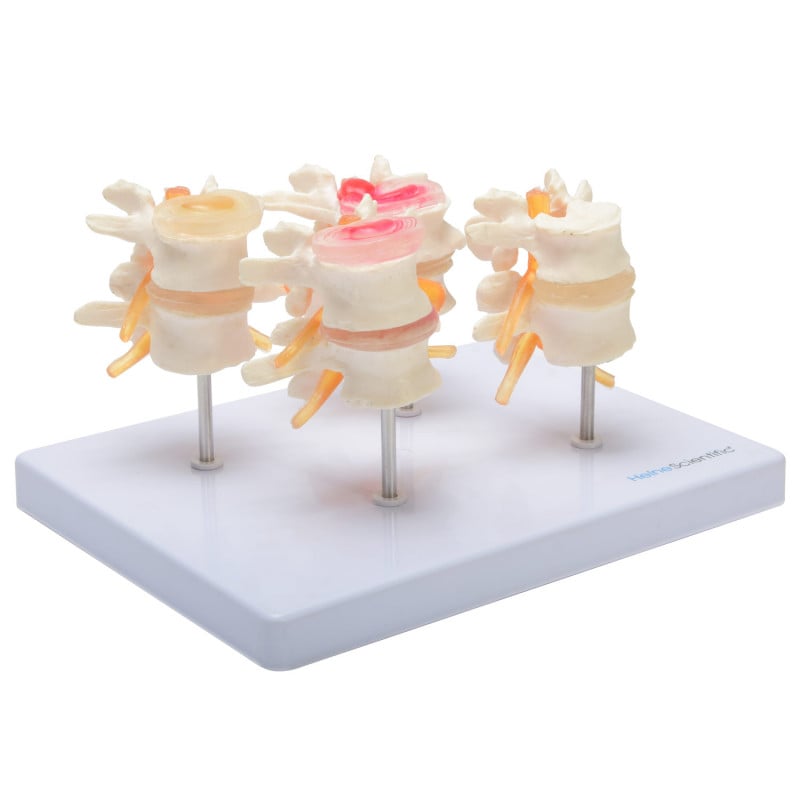HeineScientific Intervertebral Disc Model