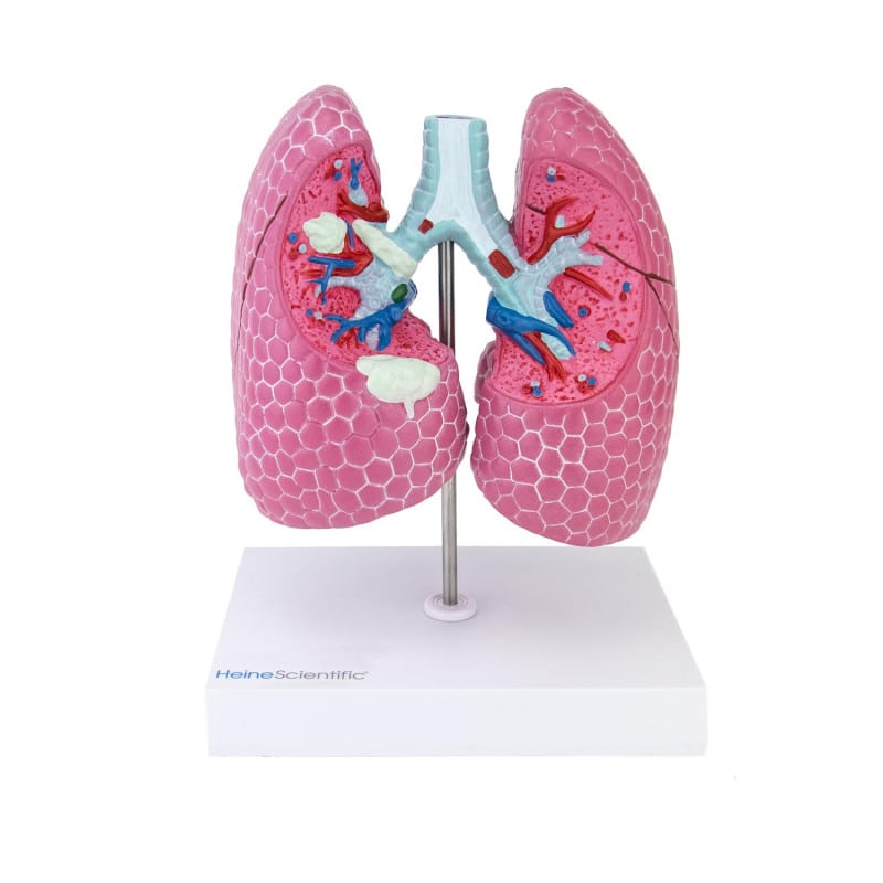 Lung Model with Diseases