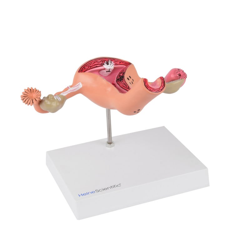 Uterus Model with Diseases