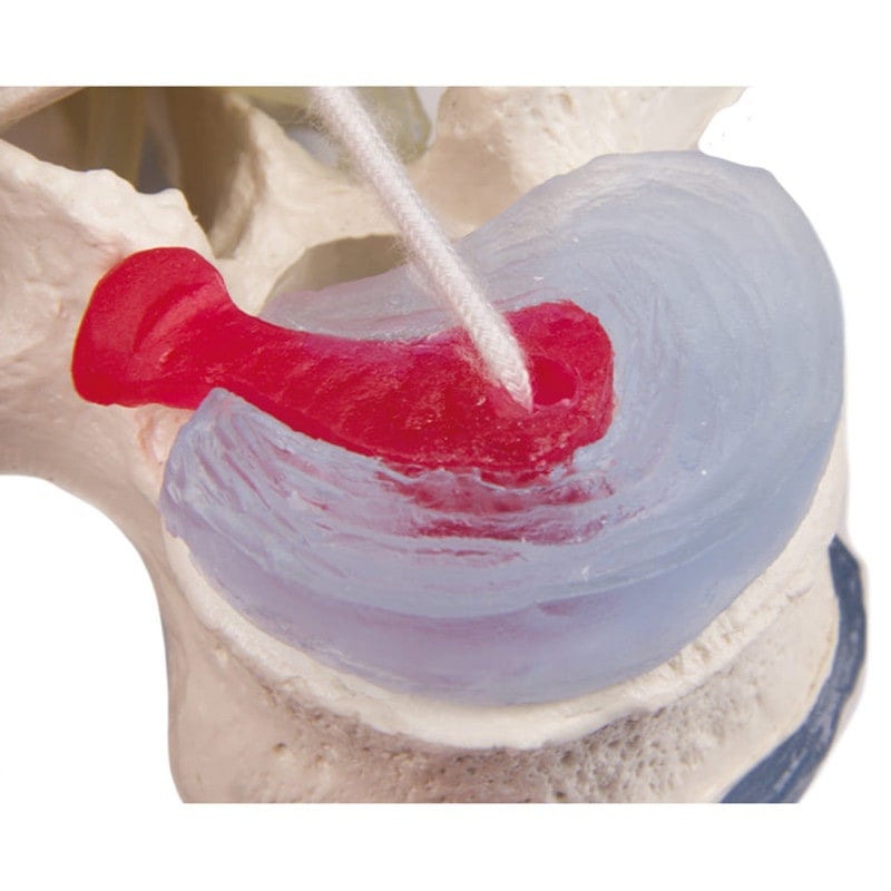 Lumbar Vertebra with Herniated Disc