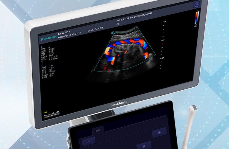 Sonoscape P15 Ultrasound Machine with battery