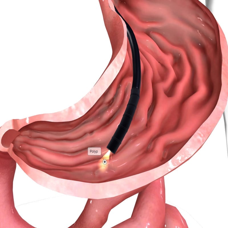 HD-500 Video Gastroscope EG-500