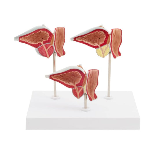3-Part Prostate Disease Model