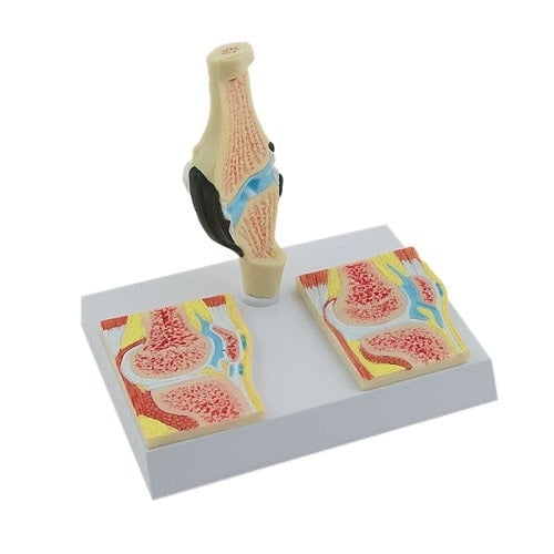 Rheumatic Knee Joint Model