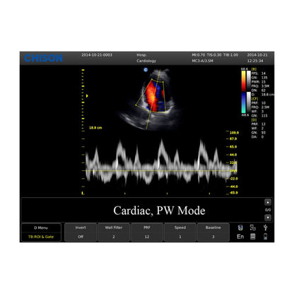 CHISON ECO5 Ultrasound Machine with Color Doppler + convex transducer