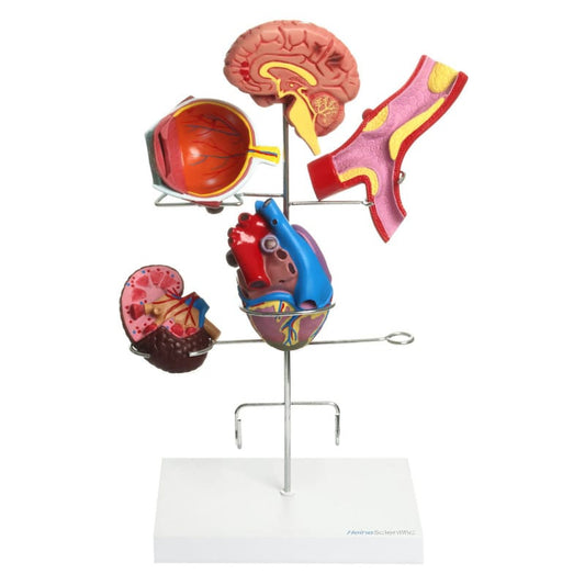 Hypertension Model Set