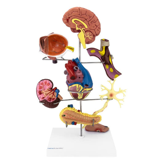 Model of Diabetes Secondary Diseases