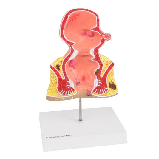 Rectum Model with Pathologies