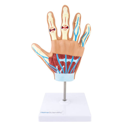 Hand Model with Rheumatoid Arthritis