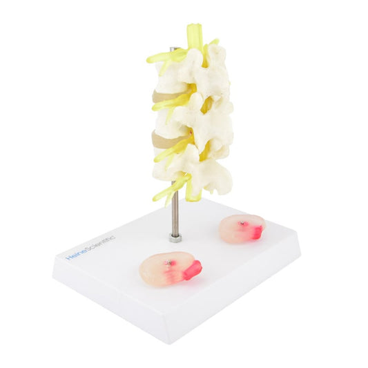Herniated Disc Model