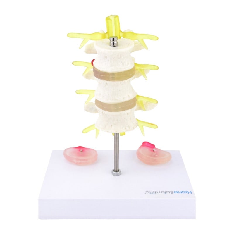 Herniated Disc Model