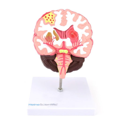 Brain Model with Diseases