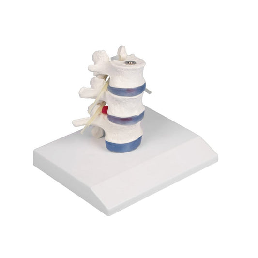 Lumbar Vertebra with Herniated Disc