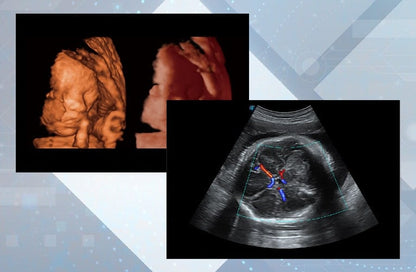 Sonoscape P15 Ultrasound Machine with battery