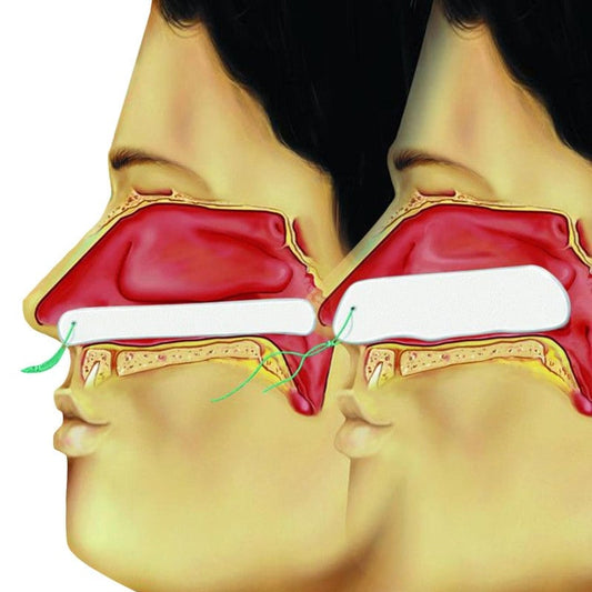 Raucocel Epistaxis Packing